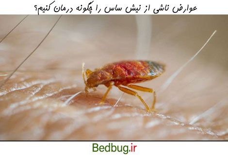 درمان عوارض نیش ساس